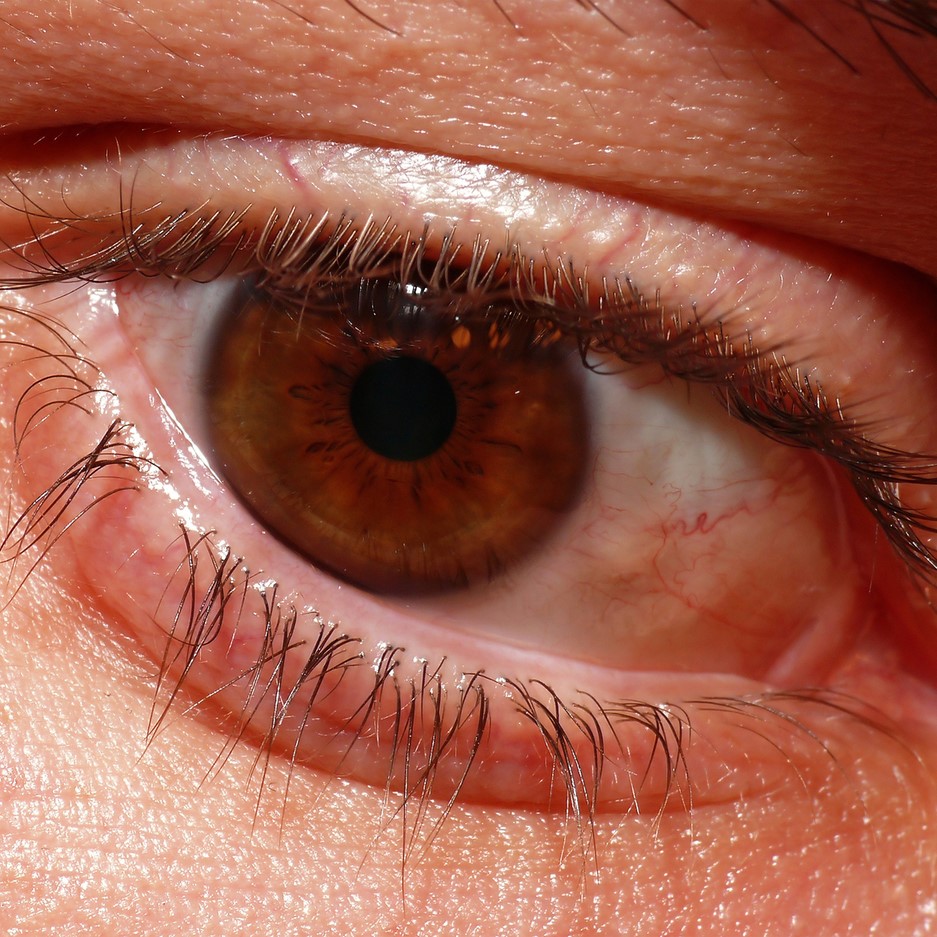 red-eyes-may-be-a-tell-tale-sign-of-coronavirus-doctor-bob