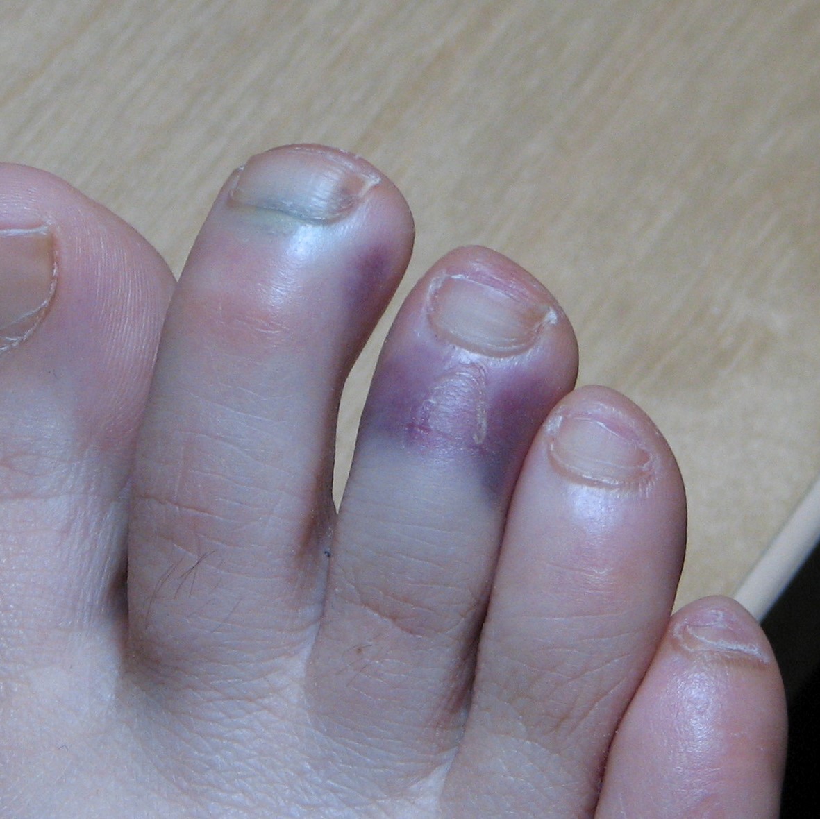 swollen purple toes        <h3 class=