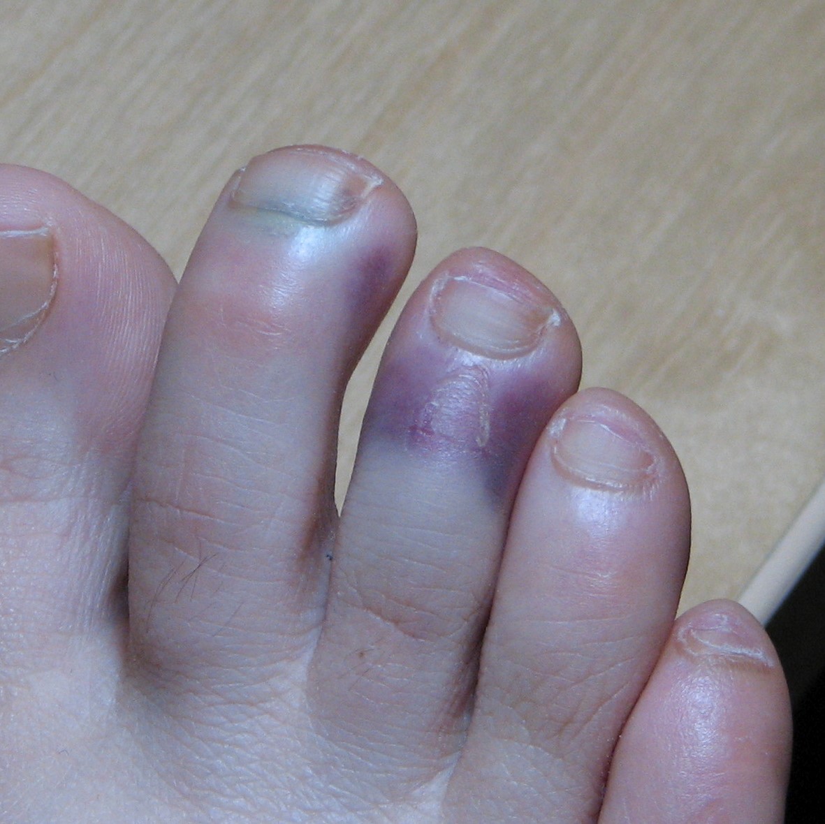 What Causes Toes To Turn Purple