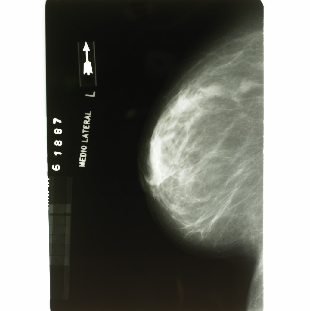 Mammogram 